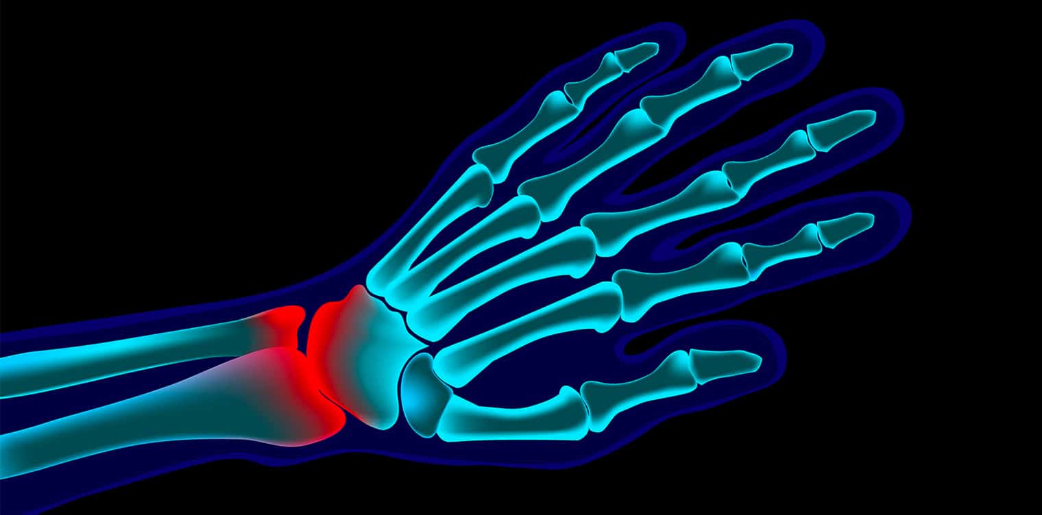 Image graphique des os de la main en bleu et vert - fracture poignet facteurs et risques | IK Paris