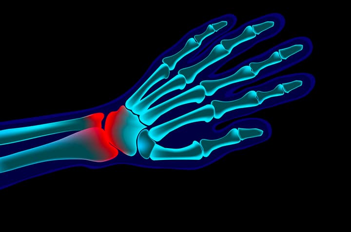 Image graphique montrant les os de la main - fracture poignet facteurs et risques | IK Paris