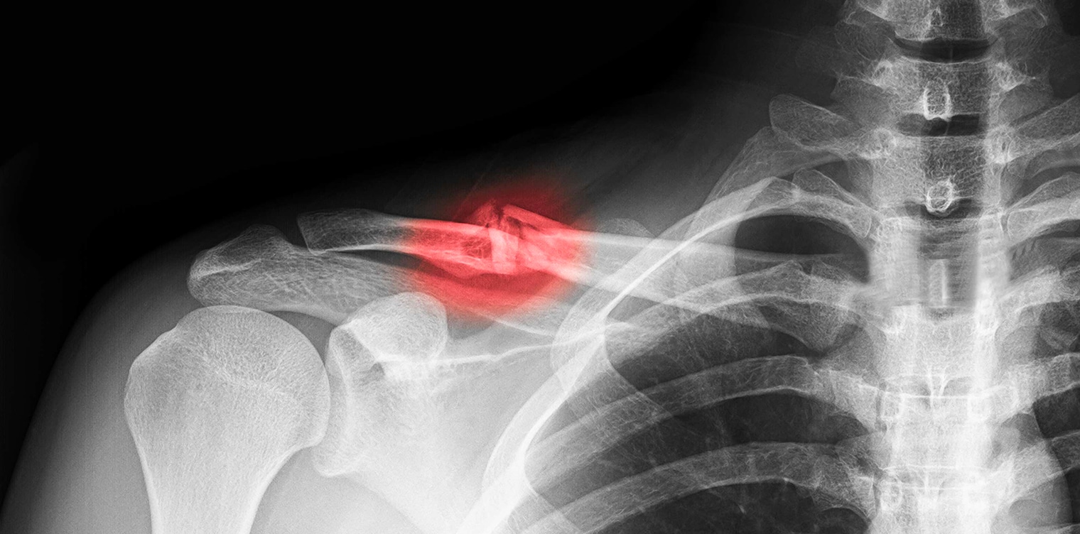 Image raon x montrant une fracture claviculaiure - fracture clavicule reeducation | IK Paris