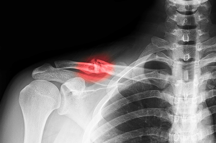 Image raon x montrant une fracture claviculaiure - fracture clavicule reeducation | IK Paris