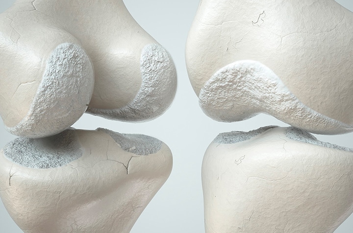 Image graphique montrant les os d articulations - causes arthrose | IK Paris